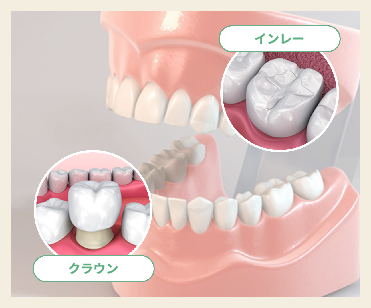 咬み合わせを正常に
