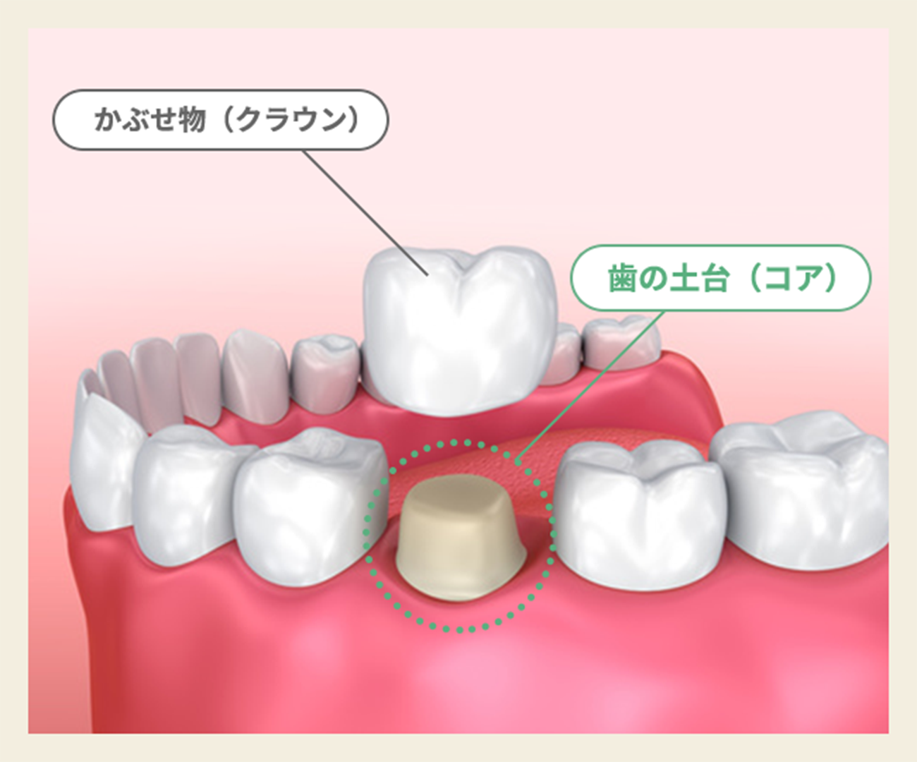 歯の土台を作る
