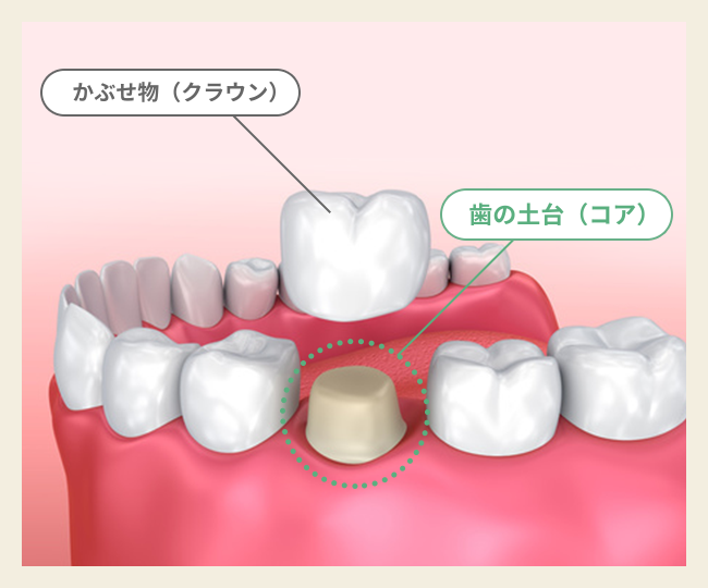 歯の土台を作る