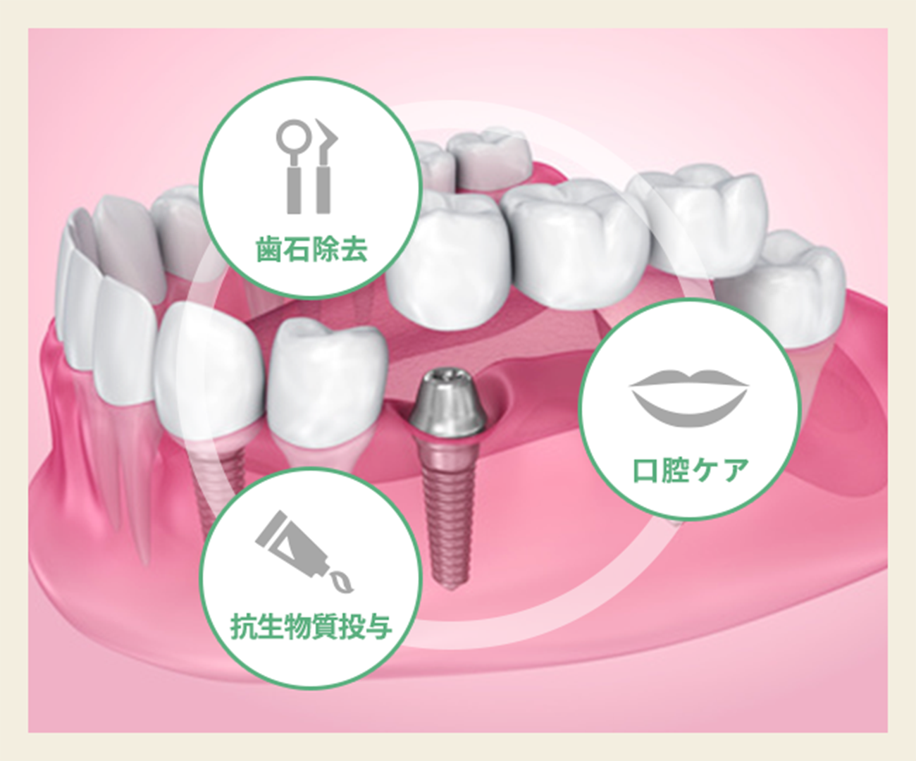 再発リスクに備える